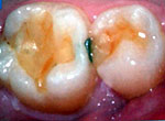 Зубы, нуждающиеся в восстановлении эмали