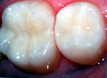 Восстановление эмали на жевательной поверхности зуба