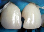 Обработка полости зуба