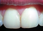 Восстановленная эмаль центрального зуба